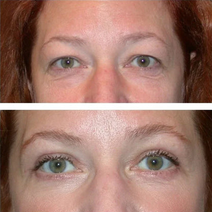 Firmer, lifted-looking eyelids in just 5 days — no strips, no surgery!