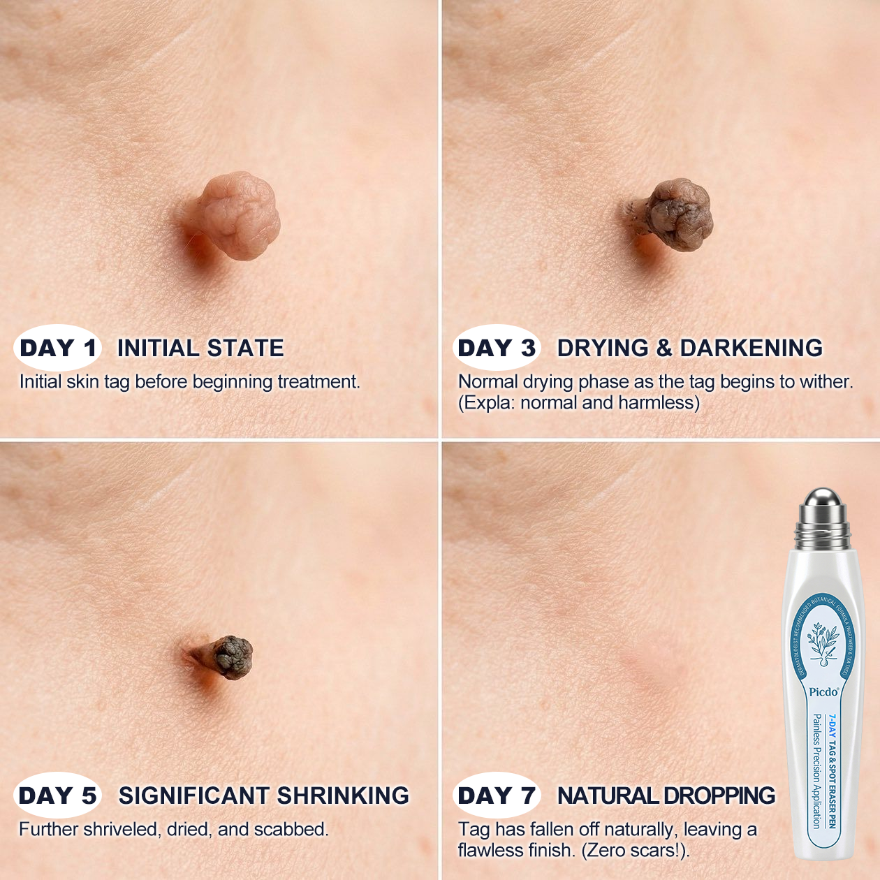 𝐎𝐟𝐟𝐢𝐜𝐢𝐚𝐥 𝐁𝐫𝐚𝐧𝐝 𝐒𝐭𝐨𝐫𝐞 |🧿𝐏i𝐜𝐝o® 7-𝐷𝑎𝑦 𝗧𝐚𝐠 & 𝗦𝗽𝐨𝐭 𝐄𝐫𝒂𝒔𝒆𝒓(Zero Pain, Zero 𝐒𝐜𝐚𝒓𝒔 Rollerball)💦